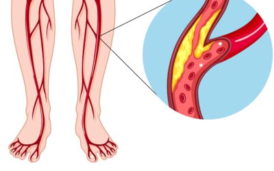 Peripheral Arterial Disease (P.A.D.)