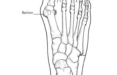 Bunions (Hallux Abducto Valgus)