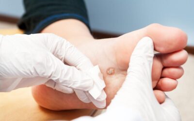 Diabetic Foot Ulcers:  Knowing risk factors can prevent amputations