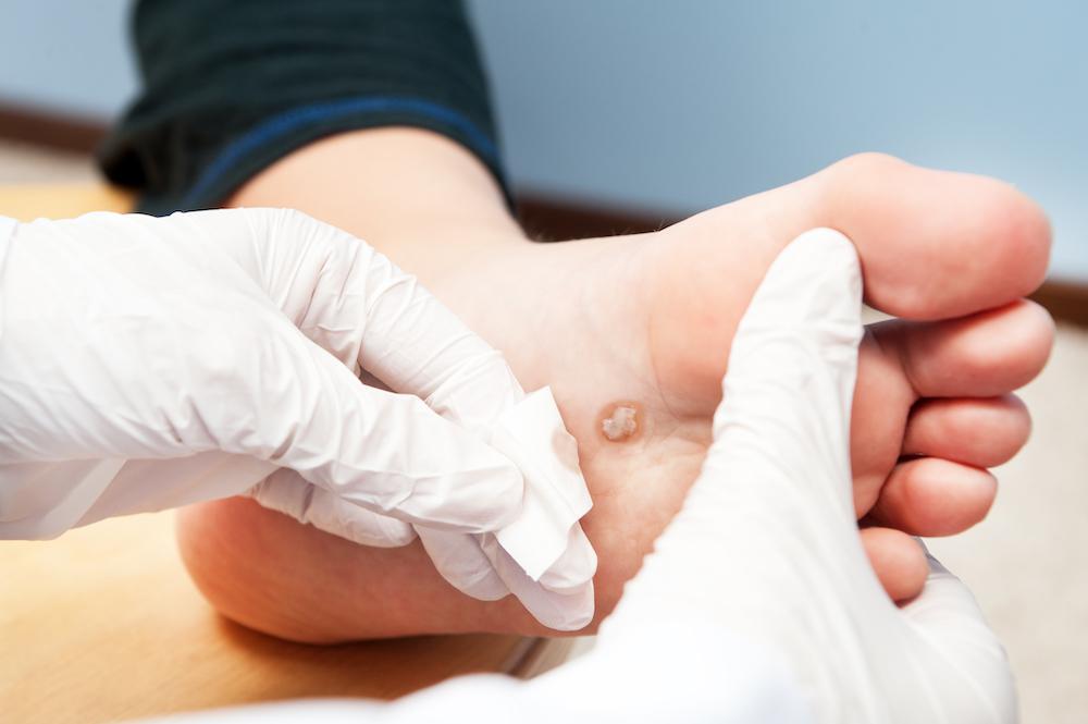 diabetic foot ulcer care
