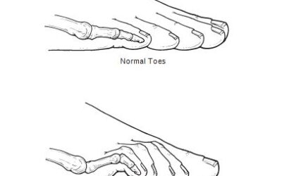 What Is Hammertoe?