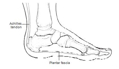 Heel Pain (Plantar Fasciitis)