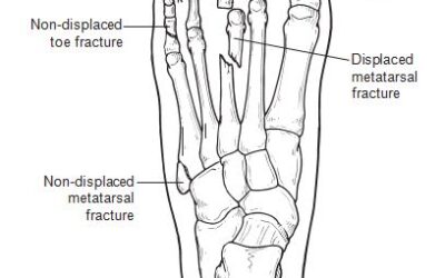 Toe and Metatarsal Fractures