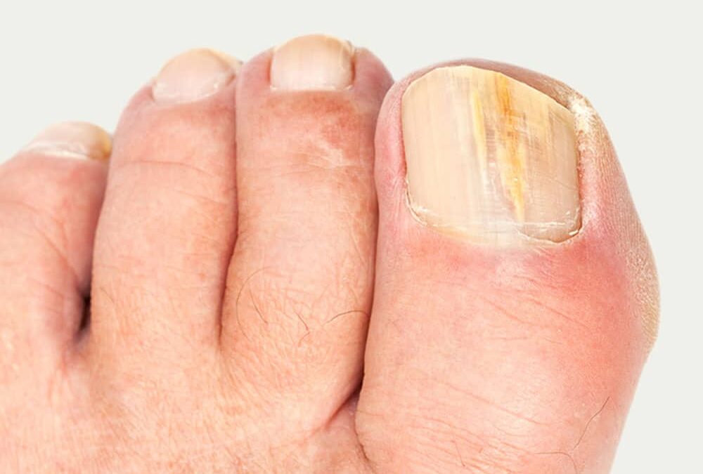 How to Deal with Fungal Toenails