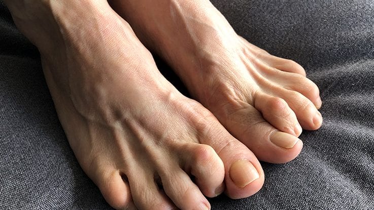 Tests and Treatments for Hammer Toes