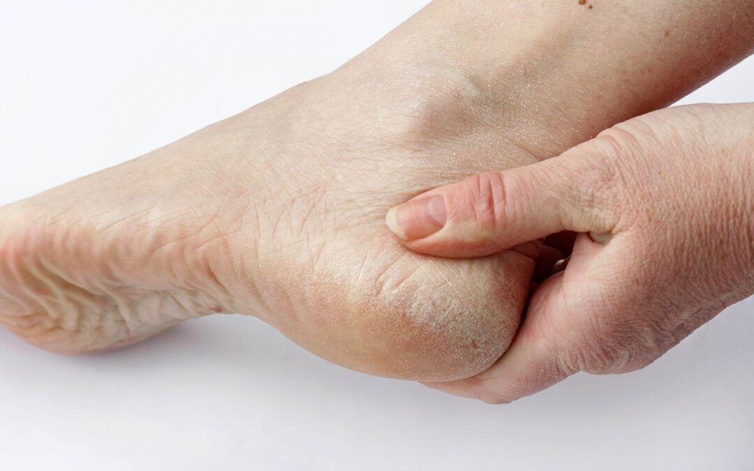 Foot Pain From Dry Skin