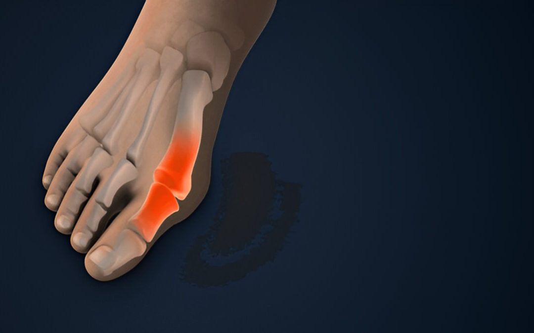 Understanding Bunions: Should You Consider Surgery?